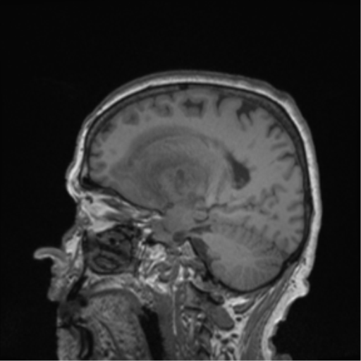 Cerebral metastasis to basal ganglia (Radiopaedia 81568-95413 Sagittal T1 47).png