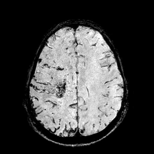 Cerebral parenchymal arteriovenous malformation (Radiopaedia 27280-27456 Axial SWI 84).jpg