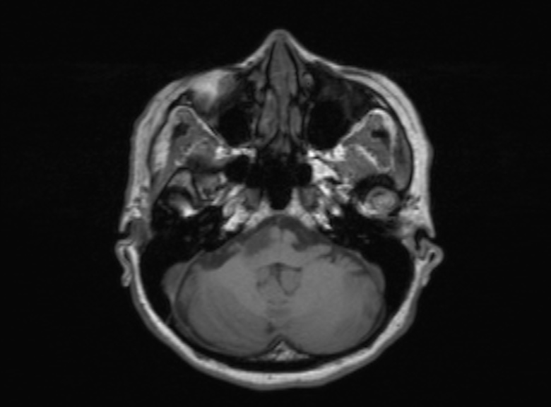 Cerebral ring enhancing lesions - cerebral metastases (Radiopaedia 44922-48817 Axial T1 308).jpg
