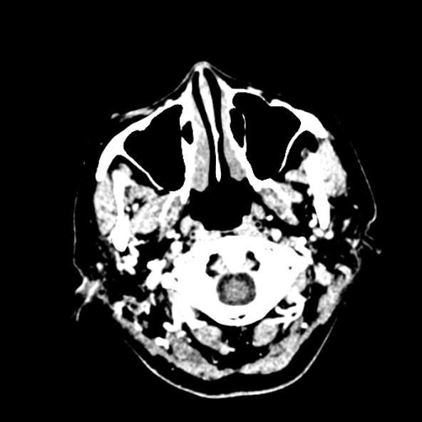 File:Cerebral ring enhancing lesions - cerebral metastases (Radiopaedia 44922-48818 B 11).jpg