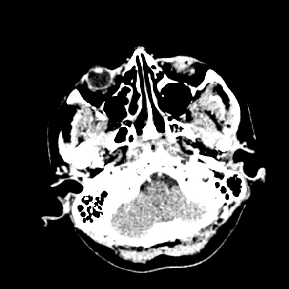 File:Cerebral ring enhancing lesions - cerebral metastases (Radiopaedia 44922-48818 B 42).jpg