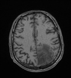File:Cerebral toxoplasmosis (Radiopaedia 43956-47461 Axial T1 55).jpg
