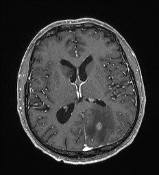 Cerebral toxoplasmosis (Radiopaedia 43956-47461 Axial T1 C+ 40).jpg