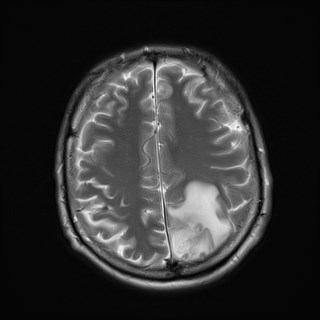 File:Cerebral toxoplasmosis (Radiopaedia 43956-47461 Axial T2 17).jpg