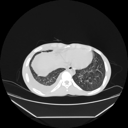 Cerebral tuberculoma (Radiopaedia 80829-94318 Axial lung window 146).jpg