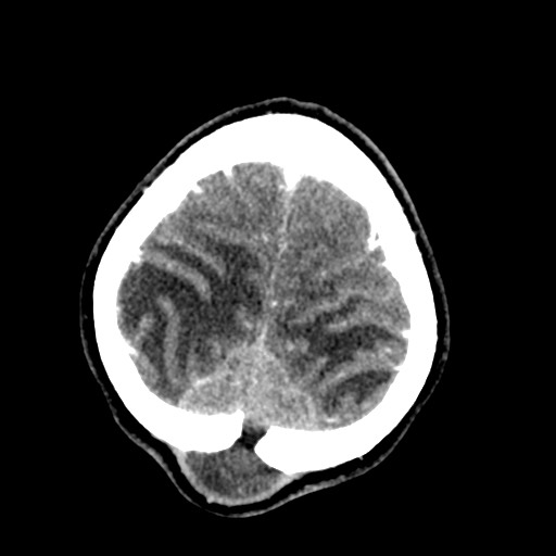 Cerebral tuberculosis with dural sinus invasion (Radiopaedia 60353-68019 Axial C+ delayed 58).jpg