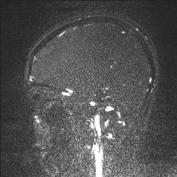 Cerebral tuberculosis with dural sinus invasion (Radiopaedia 60353-68090 Sagittal MRV 47).jpg