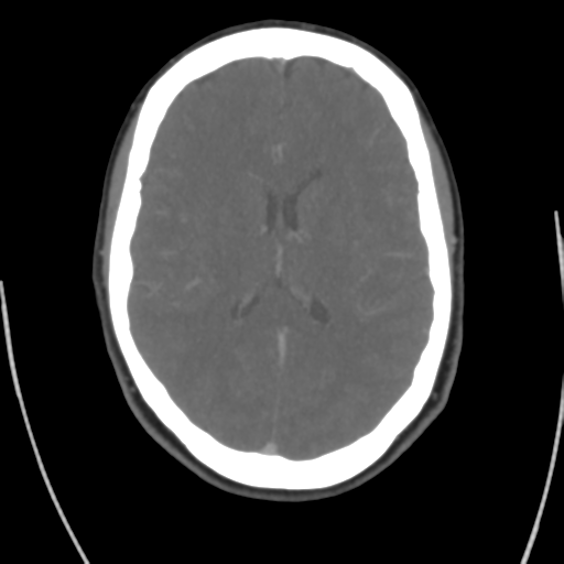 Cerebral venous infarct related to dural venous sinus thromboses (Radiopaedia 35292-36804 Axial C+ delayed 29).png