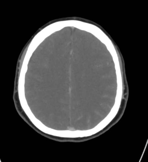 Cerebral venous infarction due to transverse sinus thrombosis (Radiopaedia 34688-36120 Axial CT venogram 34).png