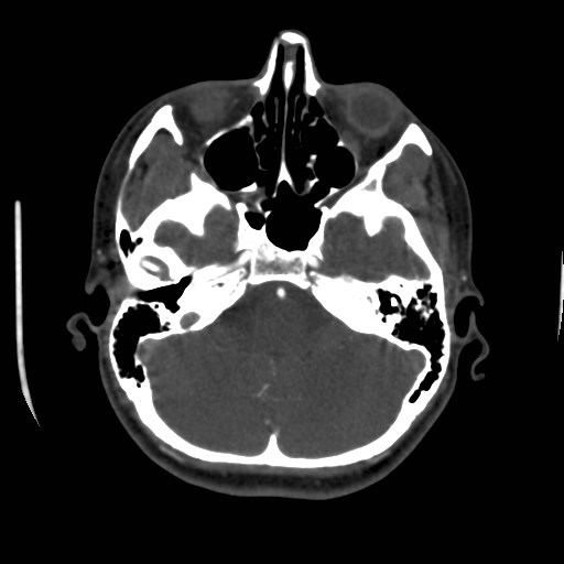 Cerebral venous sinus thrombosis (Radiopaedia 40619-43227 A 51).jpg