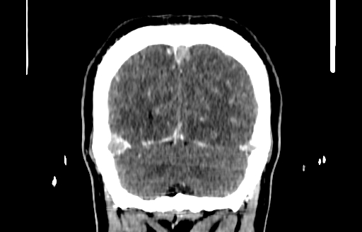 File:Cerebral venous thrombosis (CVT) (Radiopaedia 77524-89685 C 55).jpg
