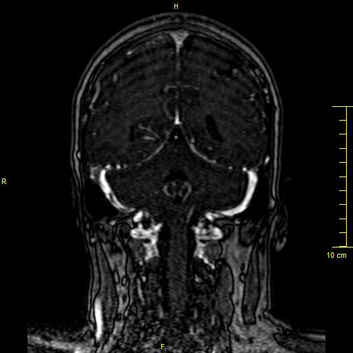 Cerebral venous thrombosis (Radiopaedia 23288-23351 MRV 115).JPG