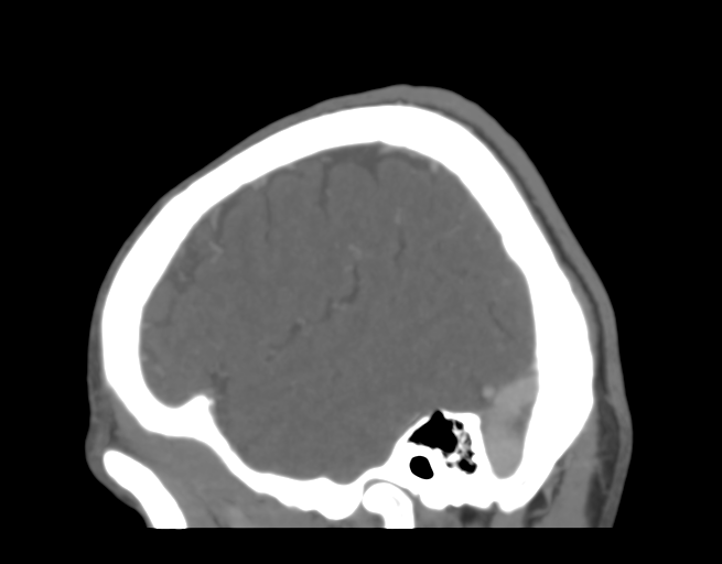 Cerebral venous thrombosis (Radiopaedia 38392-40467 D 44).png