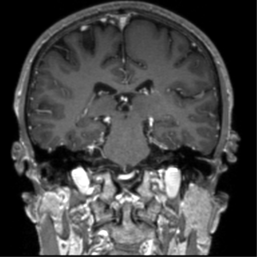 Cerebral venous thrombosis (Radiopaedia 38392-40469 Coronal T1 C+ 38).png