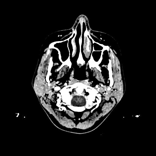 File:Cerebral venous thrombosis with venous hemorrhagic infarct (Radiopaedia 90354-107660 Axial with contrast 1).jpg