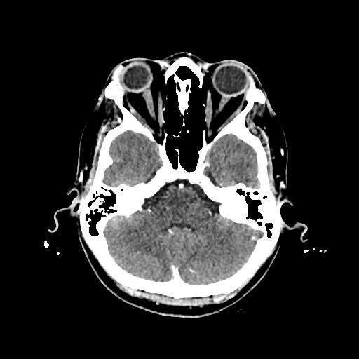 Cerebral venous thrombosis with venous hemorrhagic infarct (Radiopaedia 90354-107660 Axial with contrast 45).jpg
