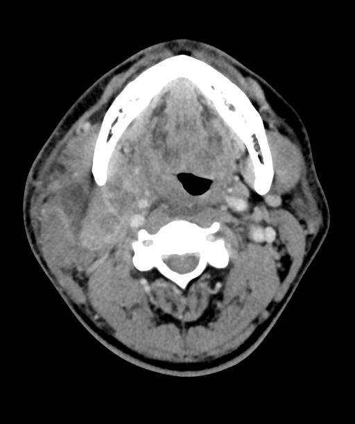 Cervical abscess (Radiopaedia 43725-47184 A 27).png