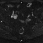 File:Cervical adenocarcinoma (Radiopaedia 65011-73985 Axial DWI 59).jpg