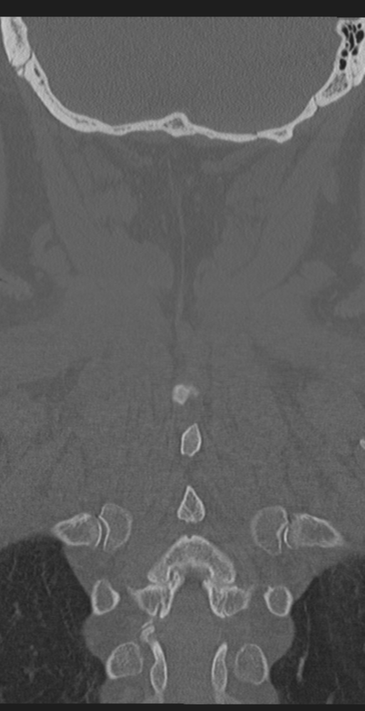Cervical canal stenosis due to ossification of the posterior longitudinal ligament (Radiopaedia 47260-51823 Coronal bone window 54).png