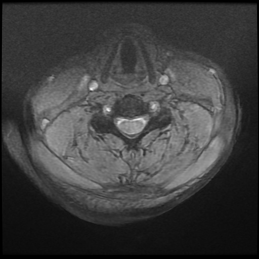 Cervical disc extrusion (Radiopaedia 59074-66364 F 27).jpg