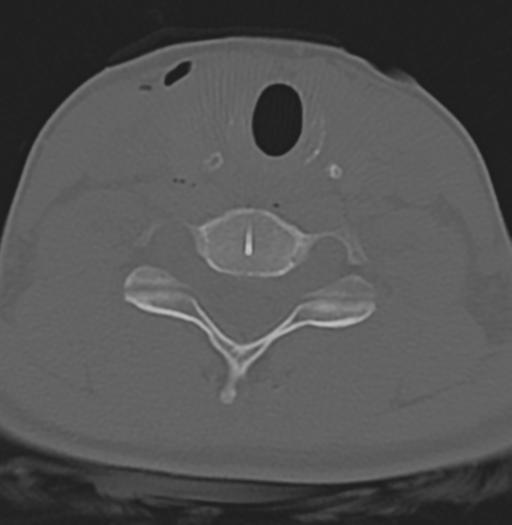 File:Cervical disc replacement (Radiopaedia 37383-39205 Axial bone window 9).png
