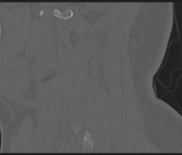 Cervical disc replacement (Radiopaedia 44025-47541 Sagittal bone window 20).png