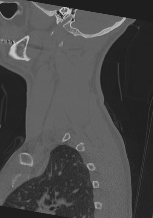 Cervical intercalary bone (Radiopaedia 35211-36748 Sagittal bone window 68).png