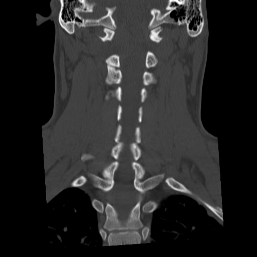 Cervical schwannoma (Radiopaedia 57979-64974 Coronal bone window 35).png