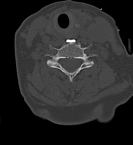 Cervical spine ACDF loosening (Radiopaedia 48998-54070 Axial bone window 39).png
