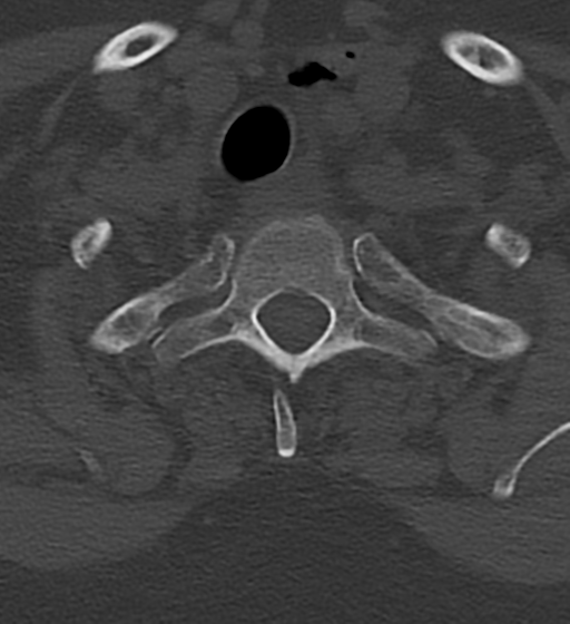 Cervical spine ACDF loosening (Radiopaedia 48998-54070 Axial bone window 55).png