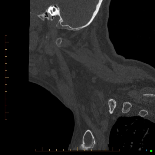 Cervical spine fracture - ankylosing spondylitis (Radiopaedia 76835-88706 Sagittal bone window 98).jpg