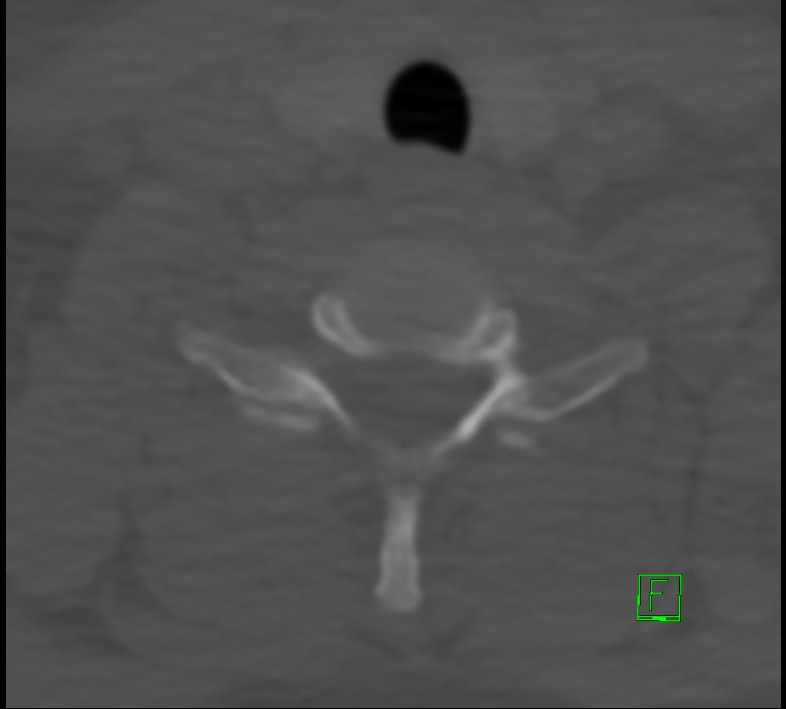 Cervical spine fracture - hyperflexion injury (Radiopaedia 66184-75364 Axial bone window 44).jpg