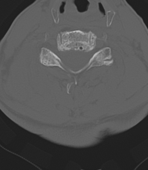 Cervical spine fractures with vertebral artery dissection (Radiopaedia 53296-59268 Axial bone window 34).png
