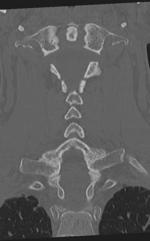 Cervical spine fractures with vertebral artery dissection (Radiopaedia 53296-59268 Coronal bone window 40).png