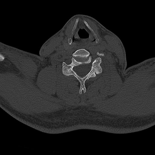 Cervical spine trauma with tear drop fracture and perched facet joint (Radiopaedia 53989-60127 Axial bone window 120).jpg