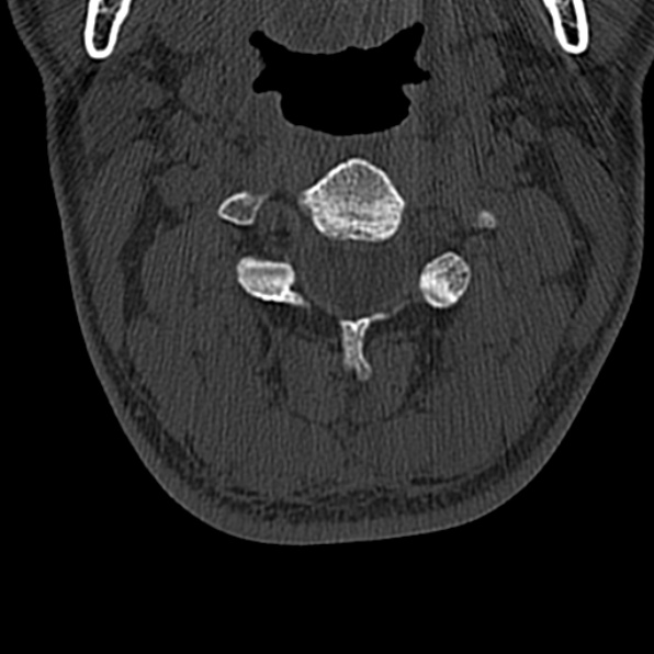 Cervical spondylodiscitis (Radiopaedia 28057-29489 Axial bone window 29).jpg