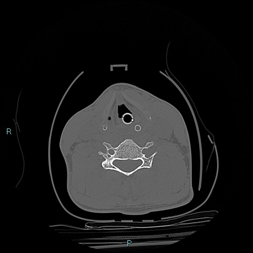 File:Cervical vertebral burst fracture (Radiopaedia 37420-39258 Axial bone window 8).jpg
