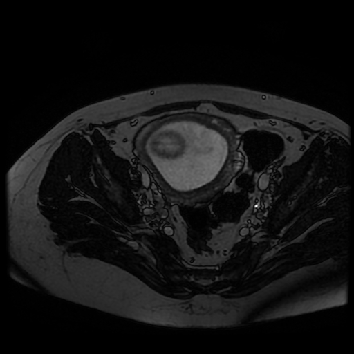 Chiari II malformation - fetal MRI (Radiopaedia 68099-77581 Axial Fiesta 49).jpg