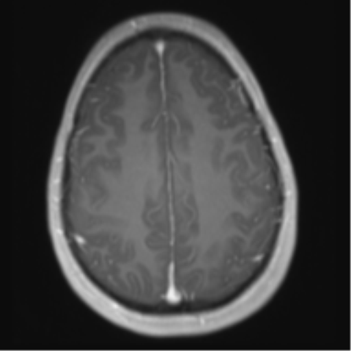 File:Chiari I malformation and obstructive hydrocephalus (Radiopaedia 41185-43978 Axial T1 C+ 25).png