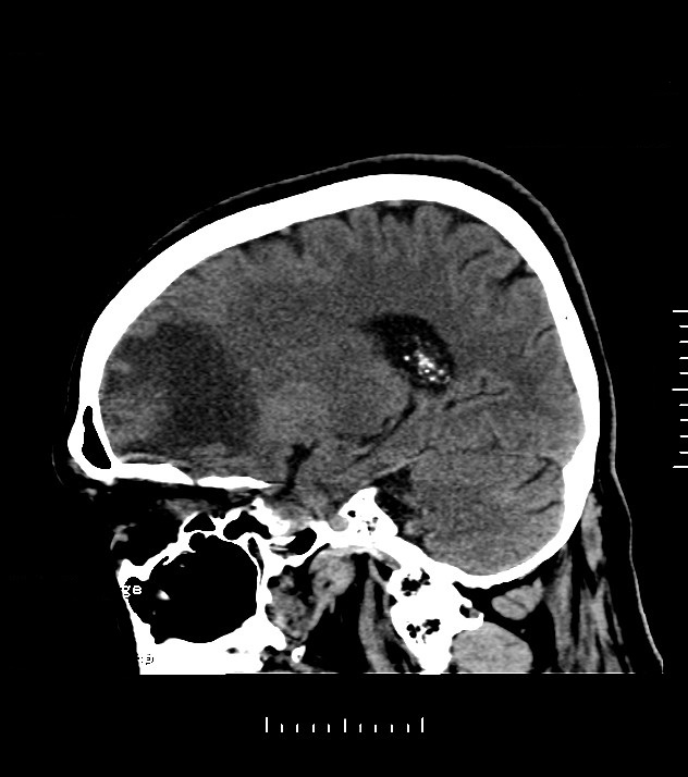 Cholangiocarcinoma with cerebral metastases (Radiopaedia 83519-98628 C 35).jpg