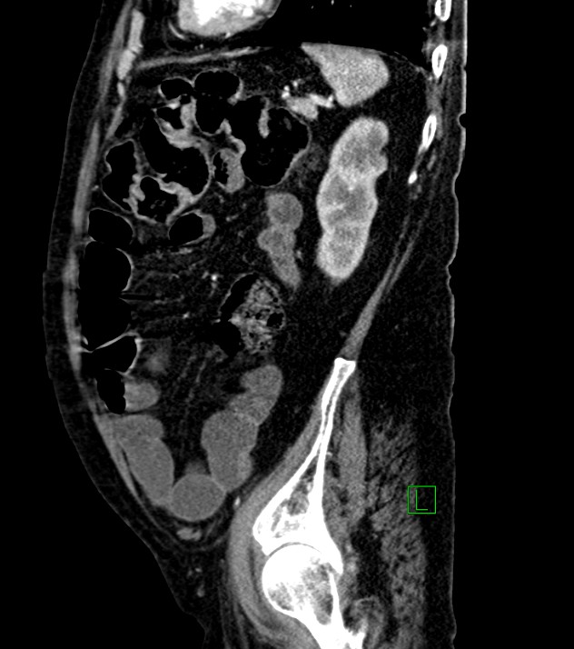 Cholangiocarcinoma with cerebral metastases (Radiopaedia 83519-98629 F 34).jpg