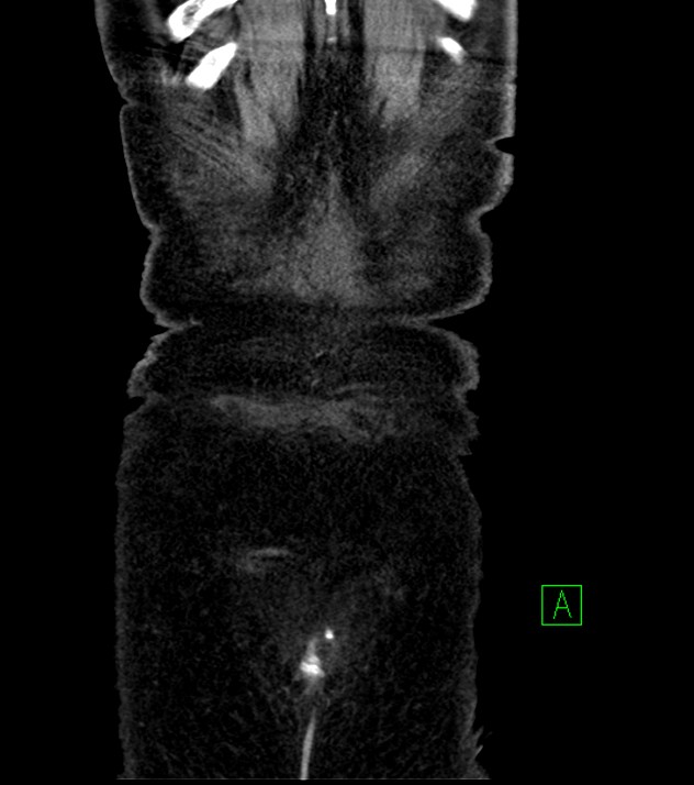 Cholangiocarcinoma with cerebral metastases (Radiopaedia 83519-98629 G 81).jpg