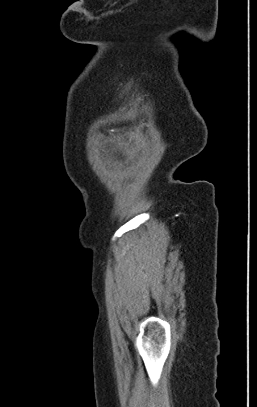 Cholecystoduodenal fistula due to calculous cholecystitis with gallstone migration (Radiopaedia 86875-103077 C 2).jpg