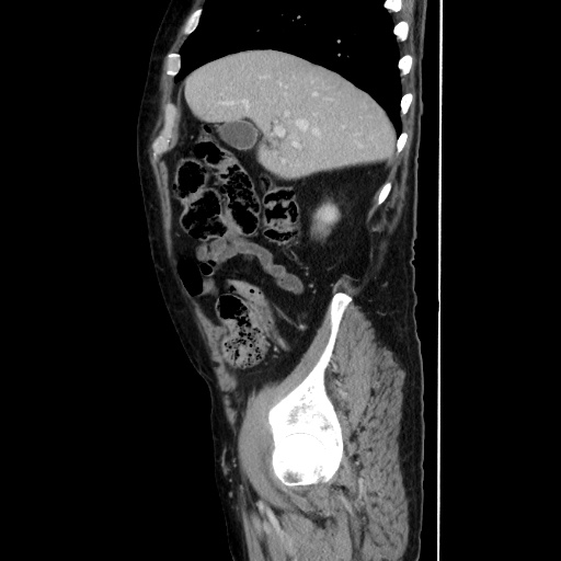Choledocholiathiasis with normal caliber common bile duct (Radiopaedia 75368-86632 D 47).jpg