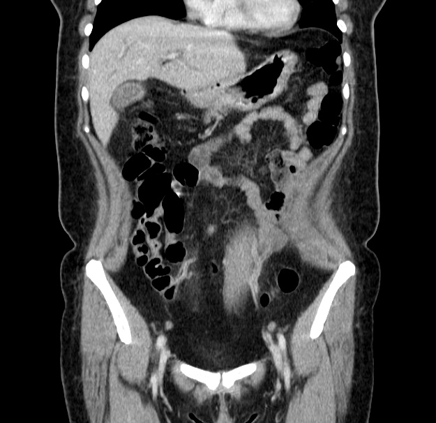 Choledocholithiasis on CT and MRI (Radiopaedia 24825-25087 C 17).jpg