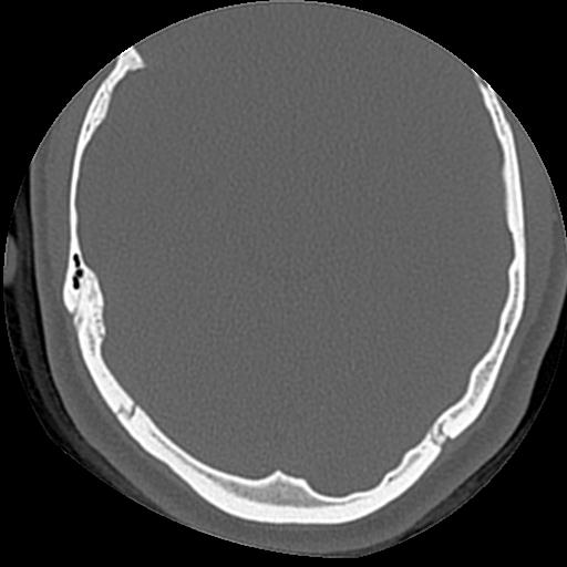 Cholesteatoma (Radiopaedia 84960-100474 Axial bone window 15).jpg