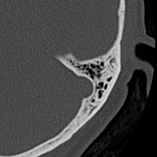 File:Cholesteatoma of the external ear (Radiopaedia 16540-16225 Axial bone window 7).jpg