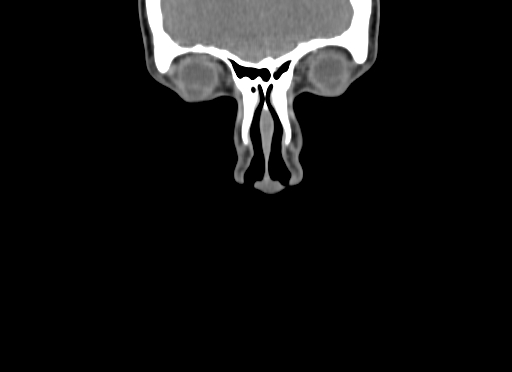 File:Chondroblastic osteosarcoma (Radiopaedia 67363-76741 D 8).jpg