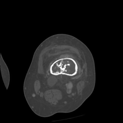 Chondrosarcoma - femur (Radiopaedia 64187-72954 Axial bone window 24).jpg