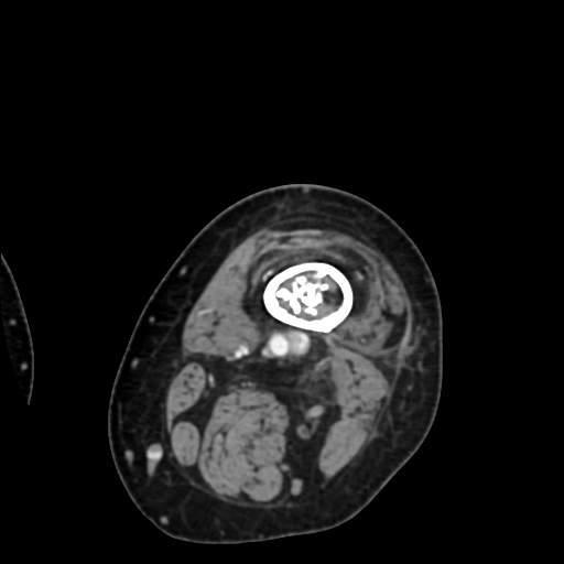 File:Chondrosarcoma - femur (Radiopaedia 64187-72954 Axial with contrast 12).jpg